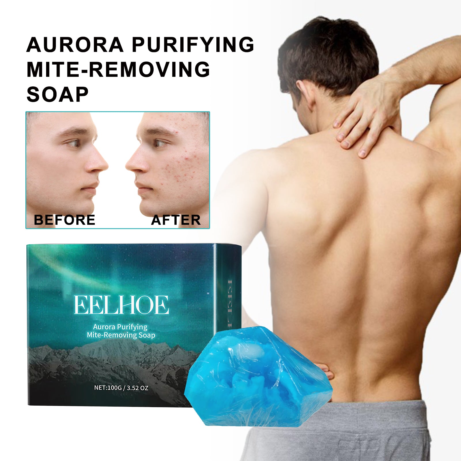 Acne Scar Fading Soap | Deep Cleansing Acne Soap | Mite Removal Cleansing Bar | Purifying Facial Soap | Anti-Acne Cleansing Soap | Skin Clarifying Soap | Gentle Acne Treatment Soap | Natural Acne Mark Removal Soap | Pore Purifying Soap | Daily Acne Defense Soap